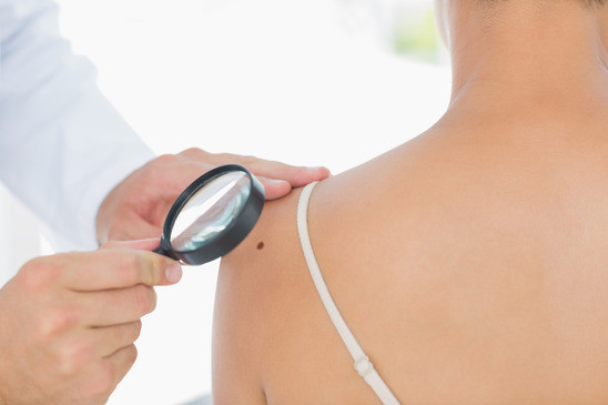 Doctor examining melanoma on woman with magnifying glass in clinic