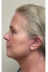 Revanesse Versa - Cheeks Before & After Patient #9208