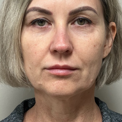 HourLift Before & After Patient #10826