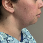 Neck Lift Before & After Patient #10814